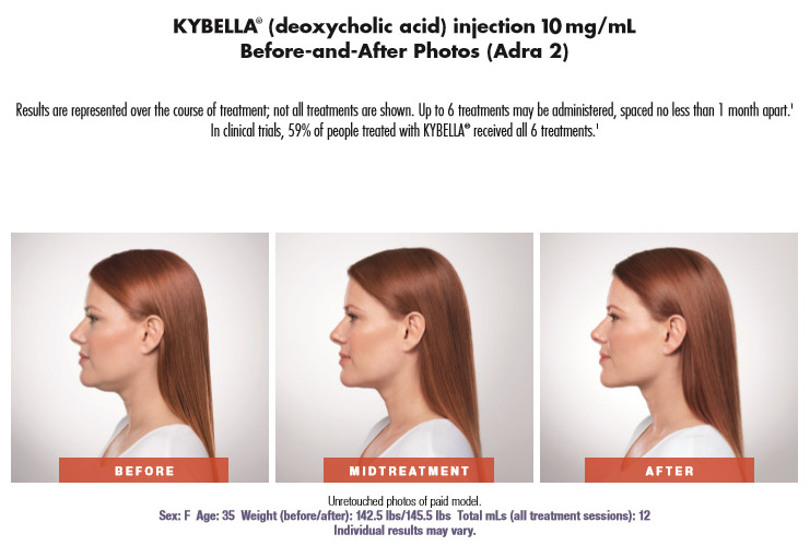 Kybella before and after photos